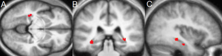 Brain scans of the hippocampus, showing the regions the researchers determined were affected by meditation.