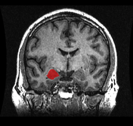The right amygdala, as revealed by functional magnetic resonance imaging.